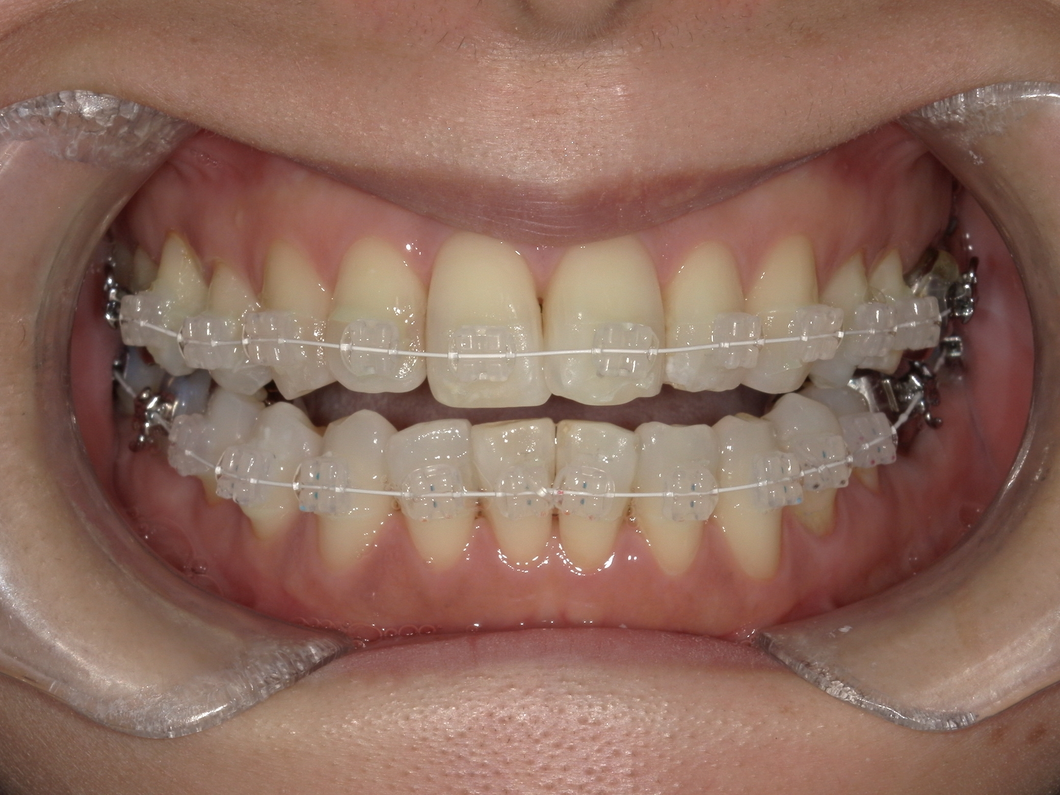 ワイヤー矯正の種類を比較！ ～それぞれのメリット・デメリット