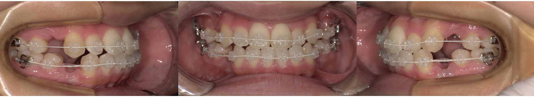自然な見た目で矯正したい方へ！審美ワイヤーの特徴とは ～審美