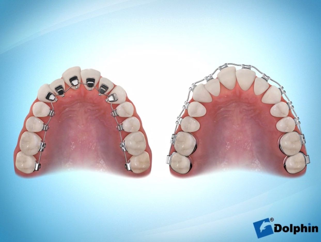 目立たない矯正治療】リンガルブラケット矯正（舌側矯正）の種類と